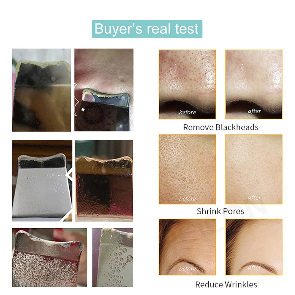 Ultrasonic Skin Scrubber – Deep Facial Cleaner & Blackhead Remover with Lifting Mode