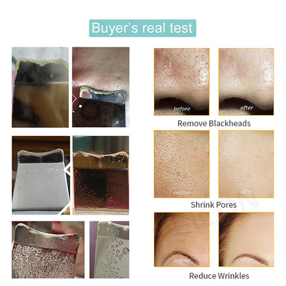 Ultrasonic Skin Scrubber – Deep Facial Cleaner & Blackhead Remover with Lifting Mode